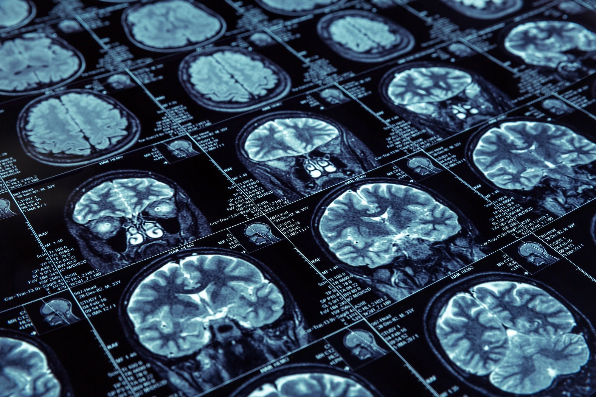PEMF and Alzheimers