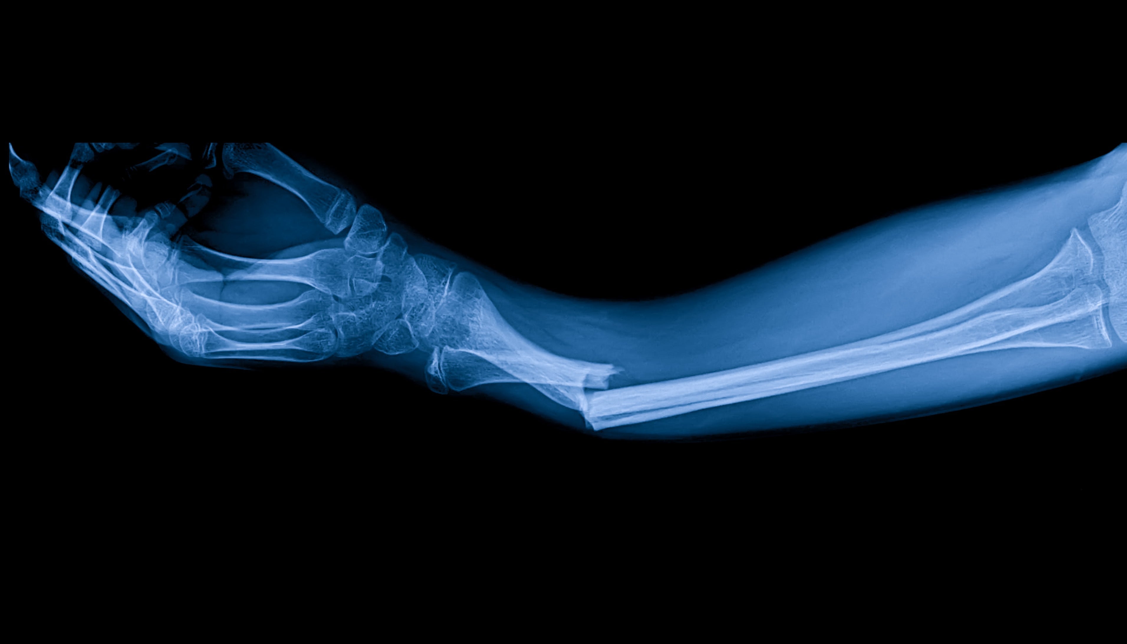 PEMF and Bone Fractures