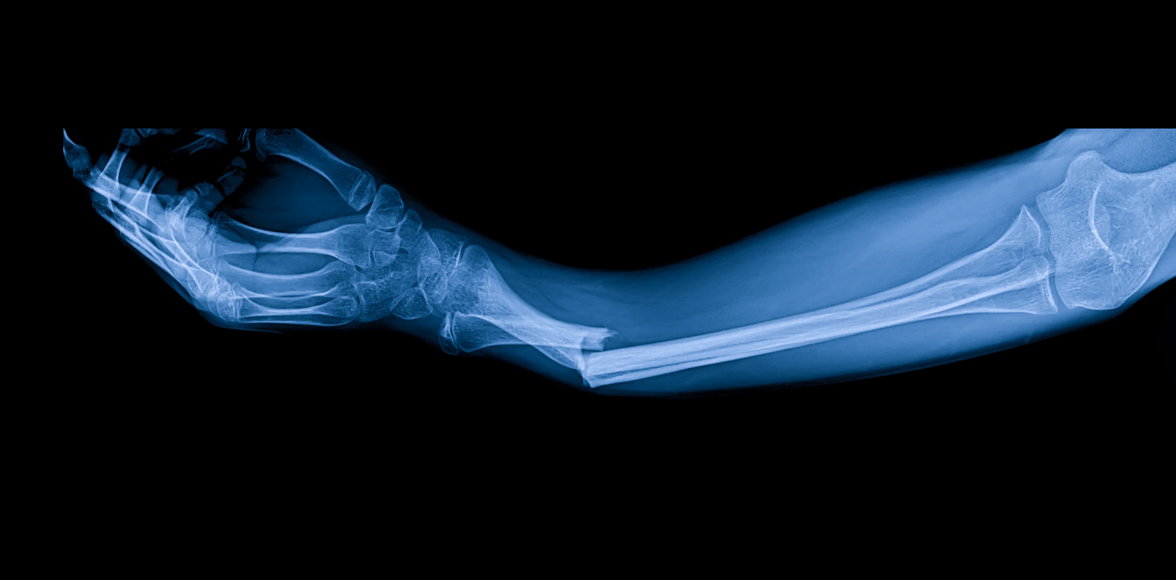PEMF and Bone Fractures