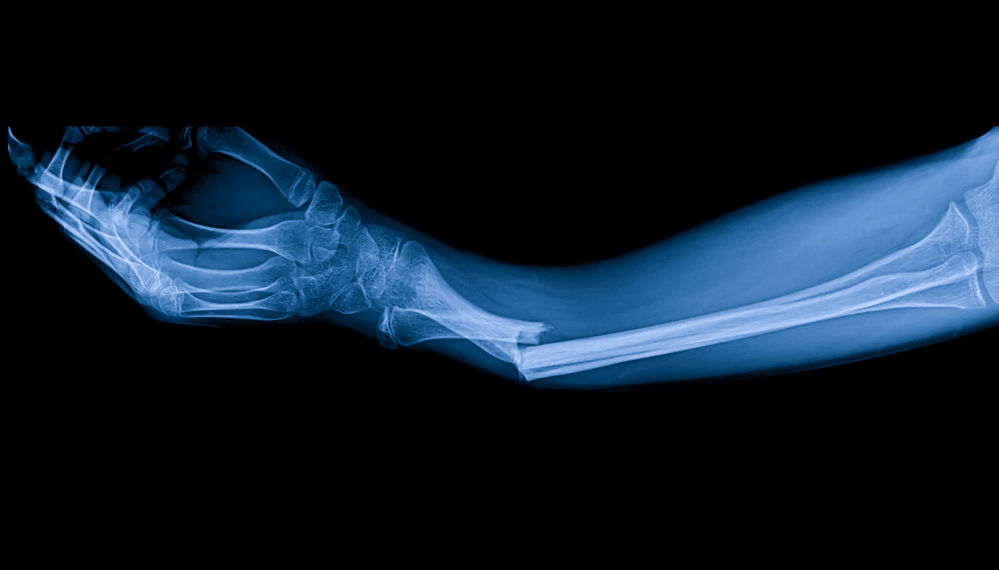 PEMF and Bone Fractures